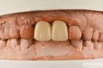 Multilayer PMMA Polymethyl Methacrylate For Dental Restorations