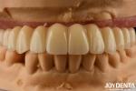 Dental Solution Ti-Base Zirconia Hybrid Bridge High Biocompatibility Natural