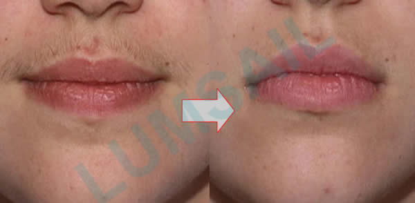 OPT SHR Permanent Hair Removal Machine For Unwanted Facial Hair / Men's Body Hair