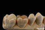 Custom Compound Inlay Onlay For Minimally Invasive Dental Restoration
