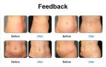 Fat burning cellulite weight loss Cold laser green RED Light 532nm 635nm