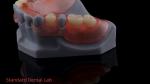 3D Print Model High Esthetics Dental TCS Valplast Flexible Partial Dentures