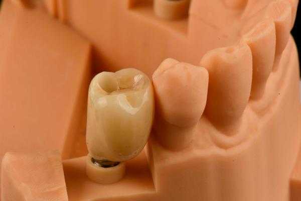 Internal Hex Connection Sandblasted Titanium Dental Implants Single Tooth