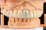 Seamless Gradient Dental PMMA Multilayer Design For Natural Shade Transitions