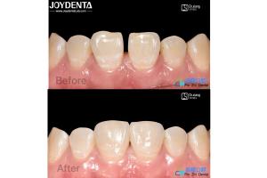 Wholesale Secure Fit Porcelain Veneers Dental Treatment Composite Resin Veneers Stain Resistant from china suppliers