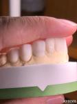 Customized Digital Diagnostic Wax Ups for Natural Tooth Anatomy Replication