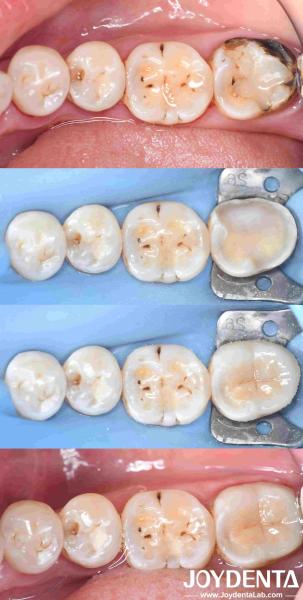 Customizable Dental Porcelain Inlay Restoration For Perfectly Fitted Teeth