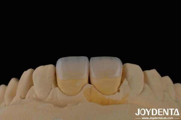 Long Lasting Dental Feldspathic Veneer Natural Tooth Color Translucent