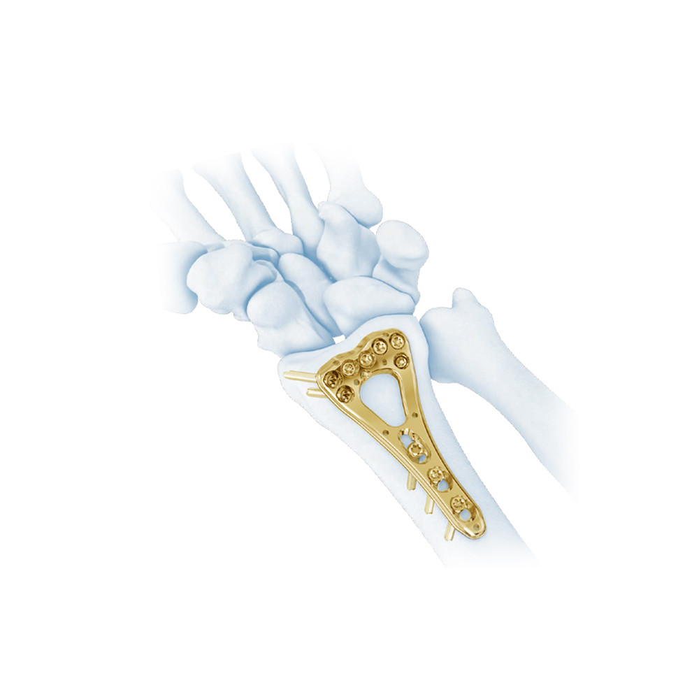 Stainless Steel / Titanium Medical Orthopedic Locking Plate Distal Radius Multi-Axial Implants