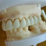 Layered Zirconia Bridge For Fixed Restoration Beautiful Smiles Professional