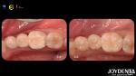 Tailored Dental Zirconia Crown Biocompatibility Comfort Customization For