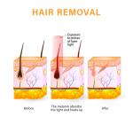 Alexandrite Diode Laser Hair Removal Machine