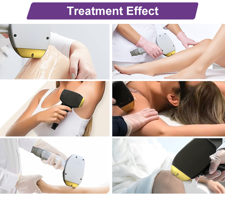 Vertical Professional Painless Lazer 808 nm Titanium Beauty Device Diode Laser Hair Removal Machine