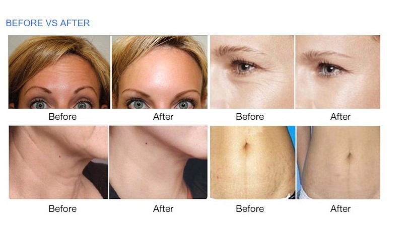 10 Mhz Skin Tightening Face Lifting Rf Lifting Machine Radio Frequency