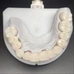 Layered Zirconia Bridge For Fixed Restoration Beautiful Smiles Professional