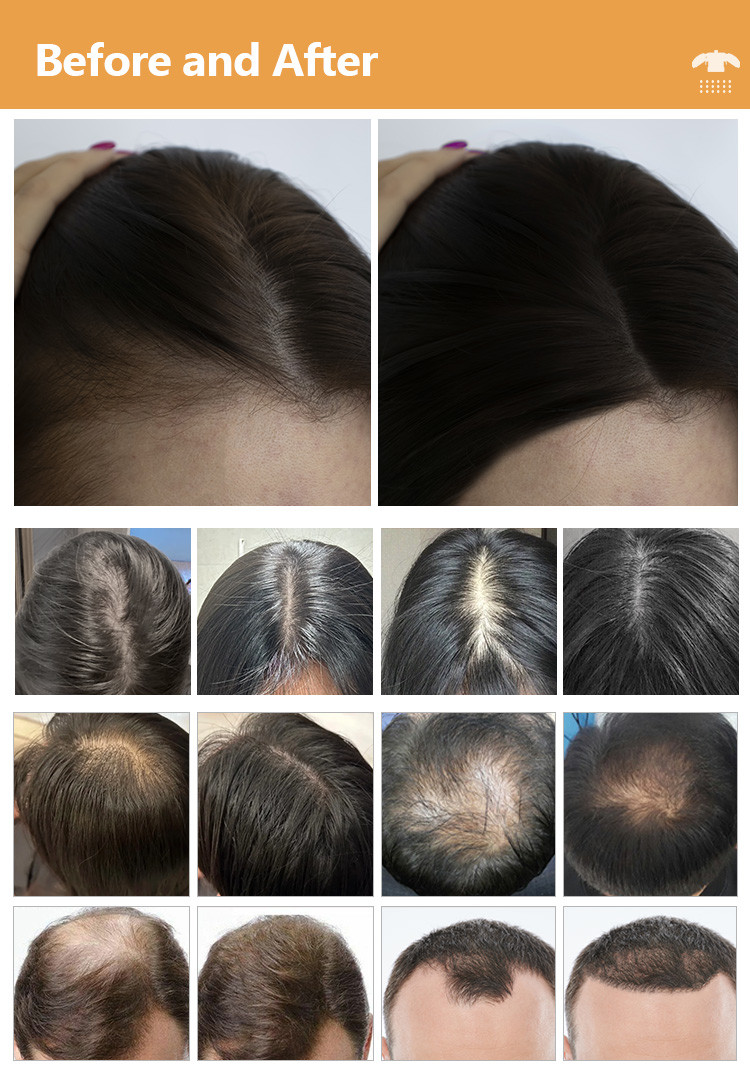 650nm 6 In 1 Laser Hair Growth Device For Scalp Care / Hair Regeneration