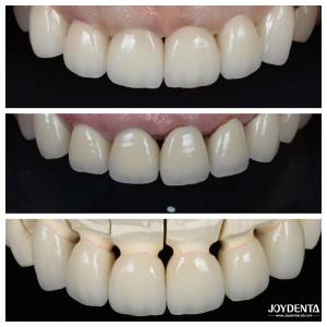 Wholesale Excellent Biocompatibility Dental Porcelain Veneers No Need For Preparation Process from china suppliers