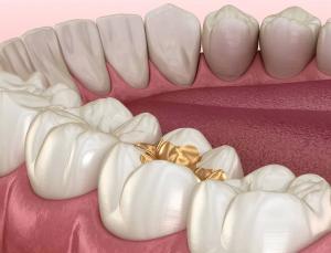 Wholesale Gold Inlay Onlay Dental Crown High Noble Yellow Ni Be Free from china suppliers