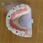 Artificial Full Arch Dental Implants Operation Cases For Surgical Procedures