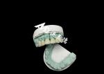 Emax Ceramic Crown Customizable and Affordable Solution for Dental Restoration