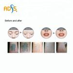Vertical ND Yag Laser Machine Laser Hair Removal And Tattoo Removal Machine