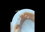 Highly-rated Solid Zirconia Crown For Satisfying Dental Restorations