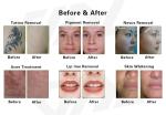 Skin Rejuvenation Pico Laser Picosend Tattoo Removal Machine Carbon Peel Beauty