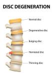 Non Surgery Cervical Decompression Machine High Negative Pressure
