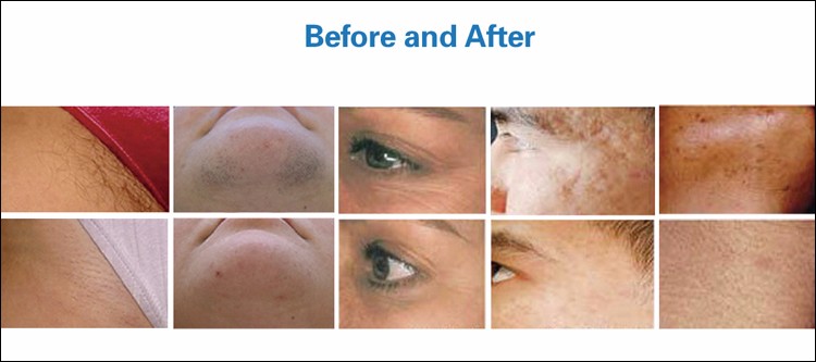 Multifunctional IPL Hair Removal Machine High Safety Without The Risk Of Injury