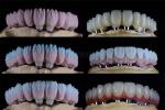 Ivoclar Implant Ball Attachments Removable Dental Implant Material For Oral