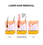 Portable Laser Hair Removal Device 810nm Permanent Hair Removal Machine For